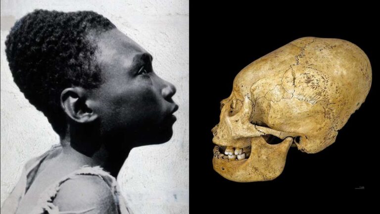 Unveiling the Secrets of Cranial Deformation: From Ancient Traditions to Modern Insights